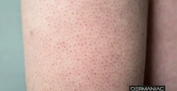 67dacbbe578956b2ab7c2887 queratosis pilaris (1)