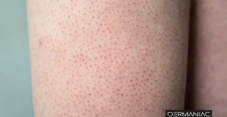 67dacbbe578956b2ab7c2887 queratosis pilaris (1)