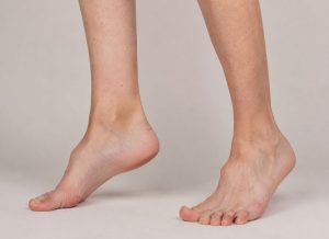 12 Key Signs of Charcot Marie Tooth Disease 768x557